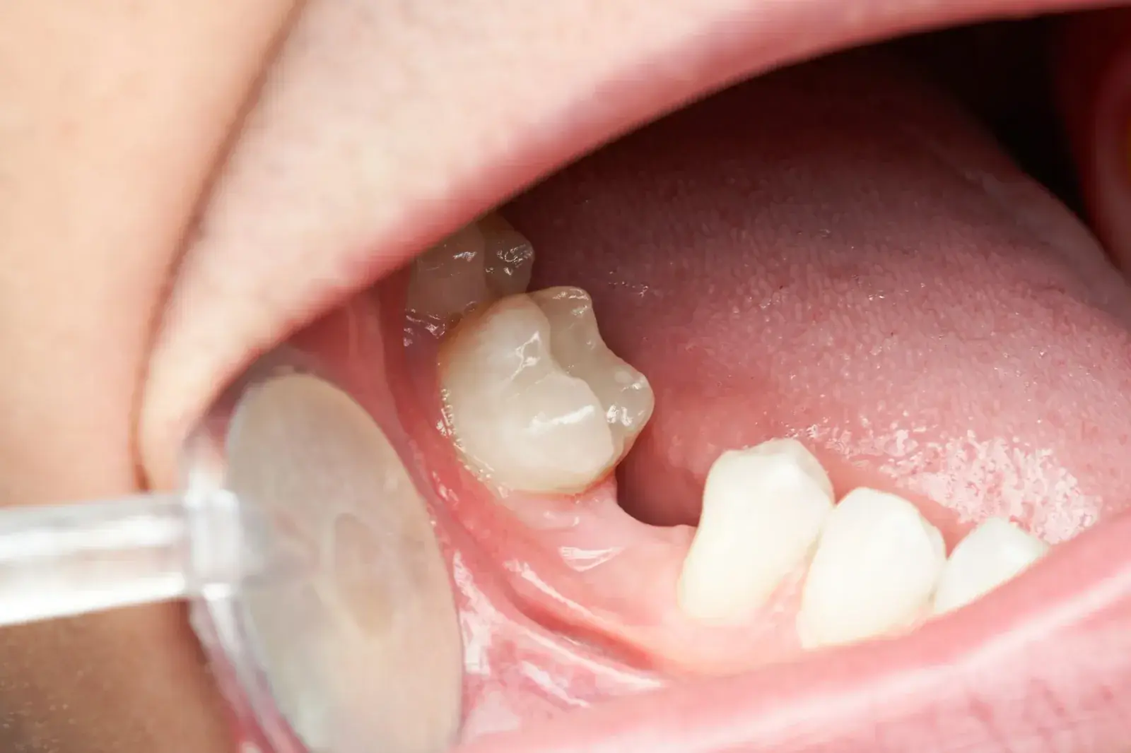 Missing Tooth