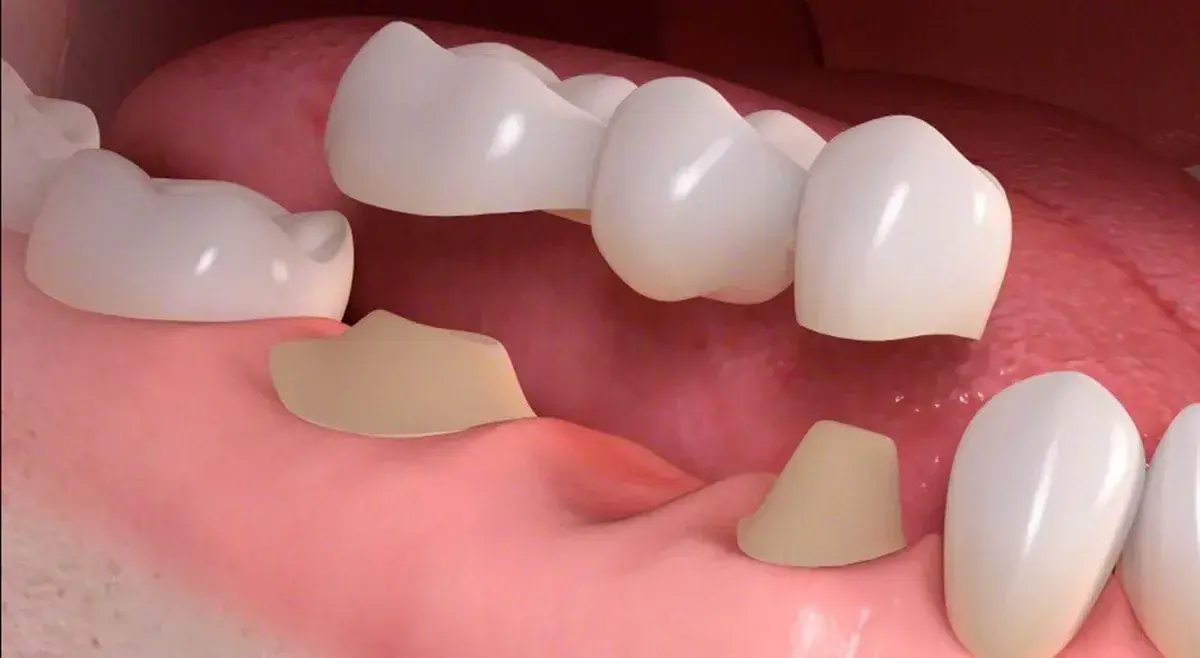 Custom porcelain dental crown