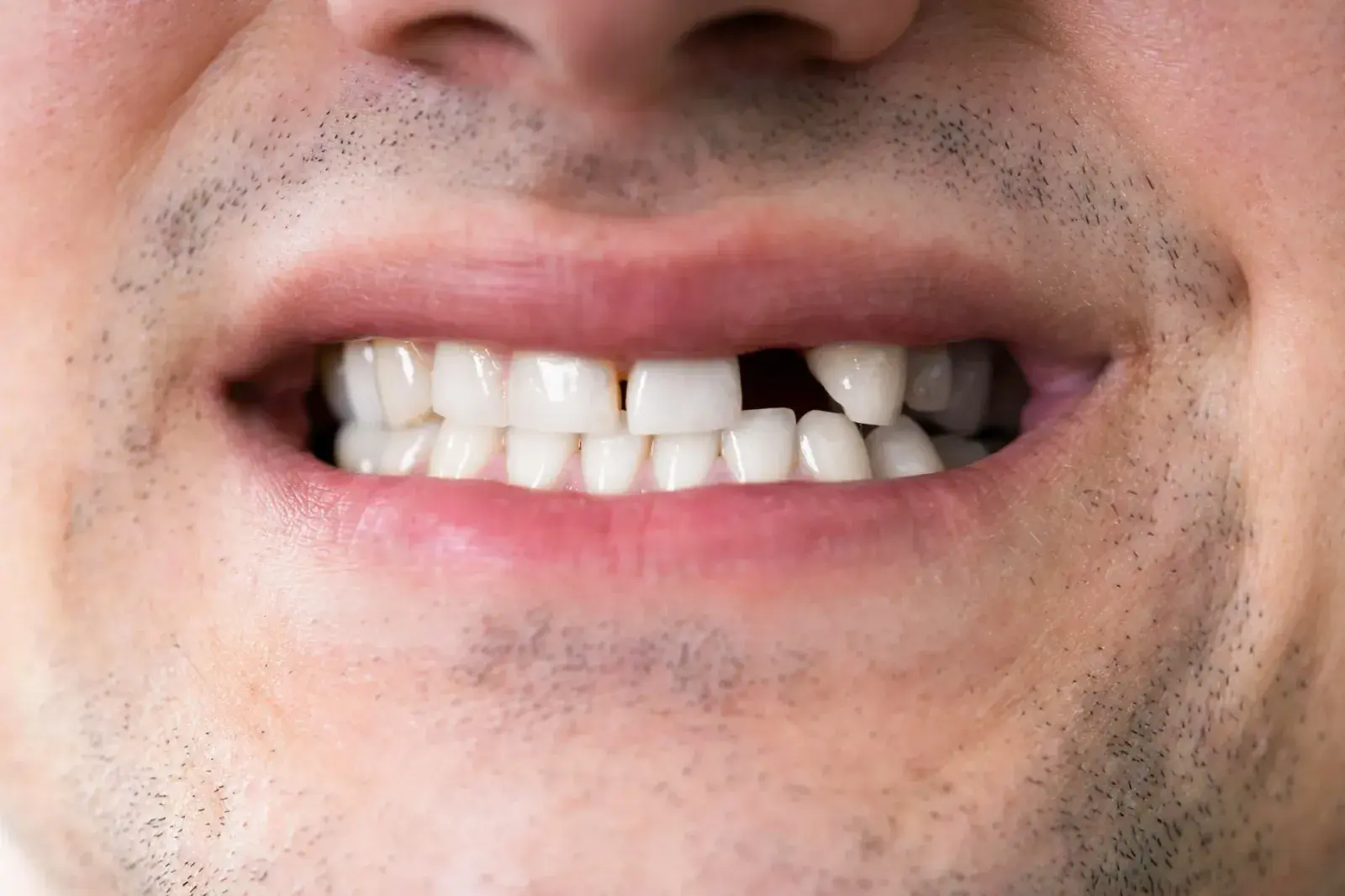 Full Mouth Restoration - before and after at London Square Dental